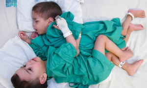 Saudi Medical Team will Conduct Syrian Conjoined Twins Surgery