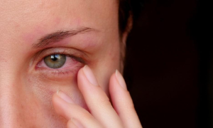 Pink Eye Disease: 85 New Infections Reported in Pakistan’s Lahore