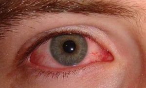 Conjunctivitis