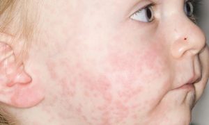 Measles