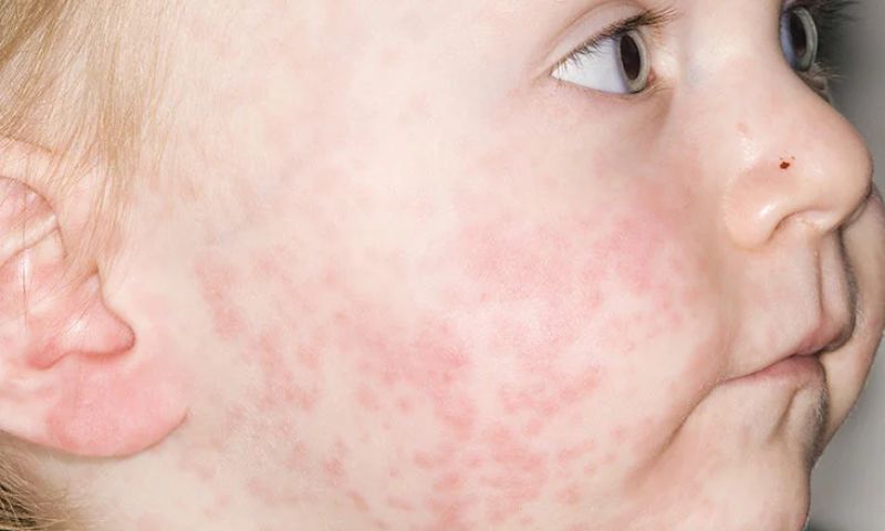 Measles