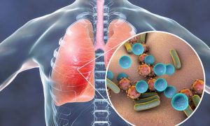 Pneumonia (