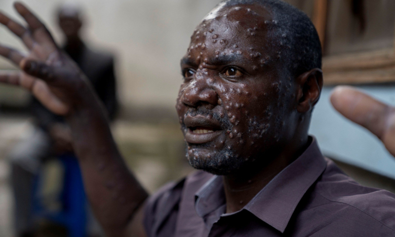 Africa CDC Prepares to Declare Public Health Emergency Over Mpox Surge