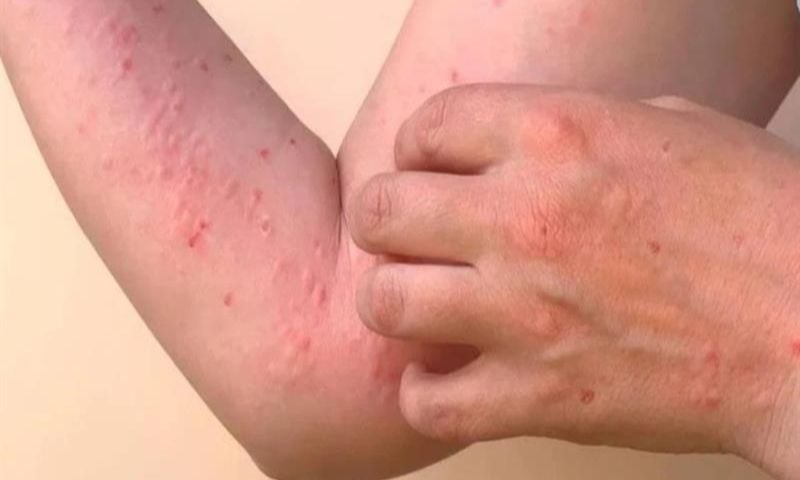 WHO, Chikungunya, Epidemic, Mosquitoes, Asia, Europe, France