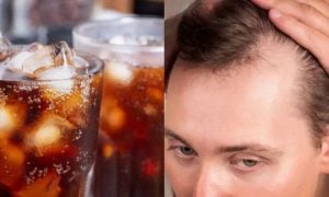 Sugary Drinks, Hair Loss, Alopecia, Vitamin D, Nutrition and Health,