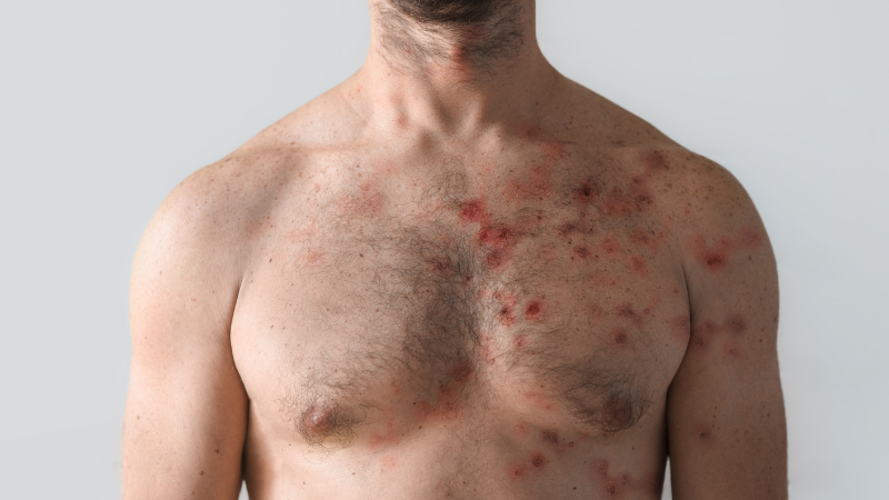 WHO says it would use the word mpox for