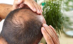 Hair loss