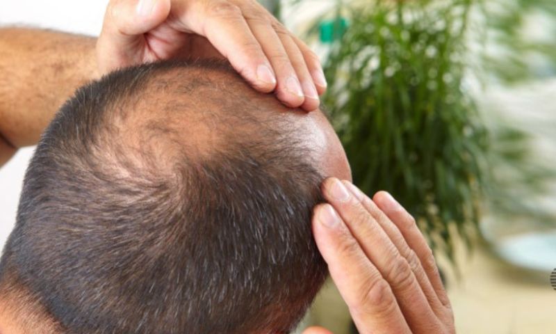 Hair loss