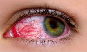 Eye