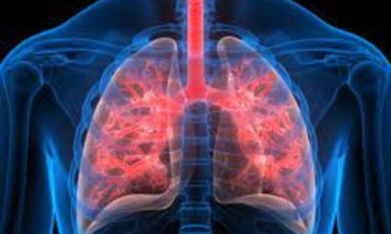 Tuberculosis
