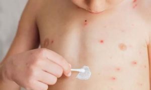 Khyber Pakhtunkhwa, Chickenpox, Azam Khan, Hospitals, Chitral, Hospitals, Virus, KP, Chief Minister