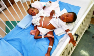Saudi Doctors to Separate Conjoined Tanzanian Twins