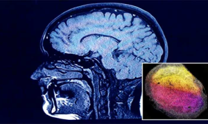 Breakthrough in Neurological Research as Scientists Grow Minibrains in Lab