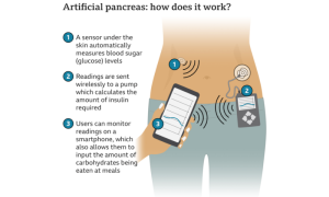 England to Offer Artificial Pancreas Technology to Diabetes Patients