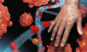 Health Specialist, Public, Vigilance, Mpox Outbreak
