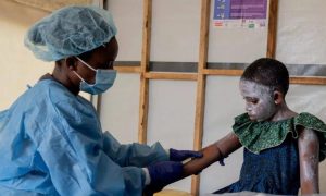 Mpox, WHO, COVID, World Health Organization, Sweden, Europe, Health, Africa,