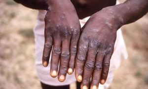 Gabon, mpox, Uganda, mpox cases, World Health Organization,