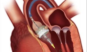 Chinese hospital, cardiovascular care, radiation-free percutaneous, heart disease, Fuwai Hospital, CAMS, heart, heart disease,