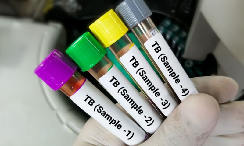 TB Tests, WHO, Tuberculosis, US, UN, India, China, Pakistan