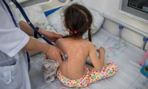 Measles