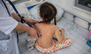 Measles Outbreak, WHO, United States, US, Donald Trump, Vaccine, Measles Vaccine, Health