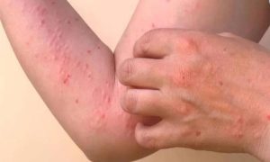 WHO, Chikungunya, Epidemic, Mosquitoes, Asia, Europe, France