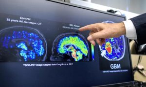 Alzheimer's, Disease, Health,