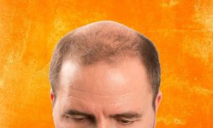 Baldness, Taiwanese Serum, Hair Fall, Hair Loss, Treatment,