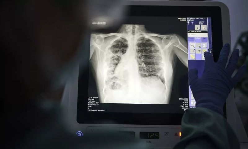 Tuberculosis, TB Deaths, Disease, Deaths, WHO, HIV, Pakistan, Diabetes, TB Treatment,