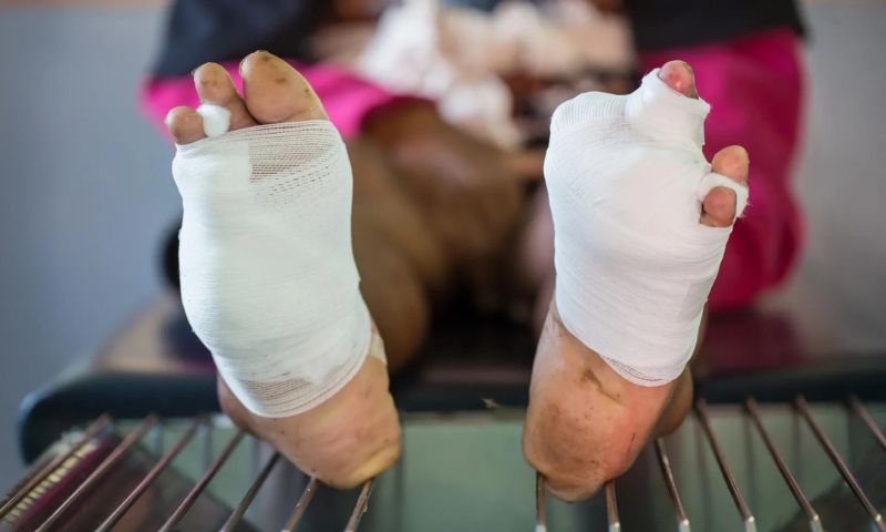 New Oxygen Gel Shows Promise in Healing Chronic Diabetic Wounds