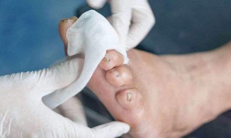 New Oxygen Gel Shows Promise in Healing Chronic Diabetic Wounds